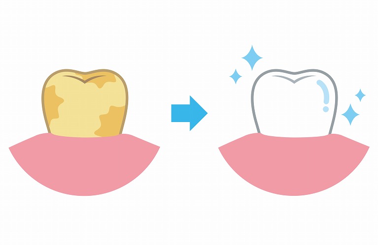 口腔内を清潔に保つ歯のクリーニング