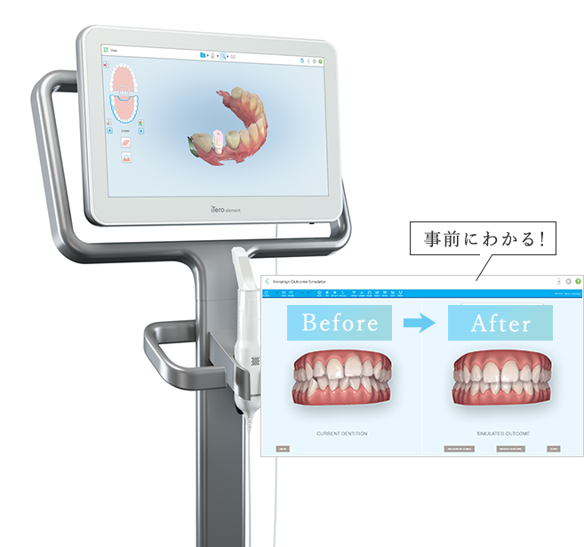 デジタル印象採得装置【iTero】を完備！事前に矯正後のイメージを画像で見ることが出来ます