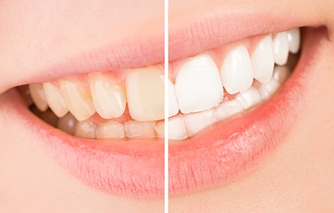 歯並びを綺麗にすると同時にホワイトニングやクリーニングが可能！