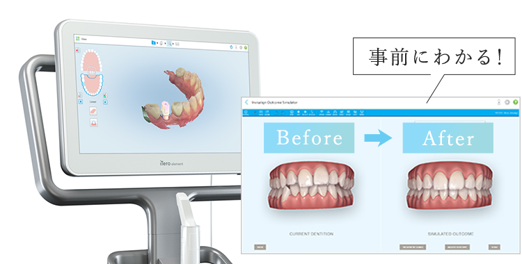 デジタル印象採得装置【iTero】を完備！事前に矯正後のイメージを画像で見ることが出来ます